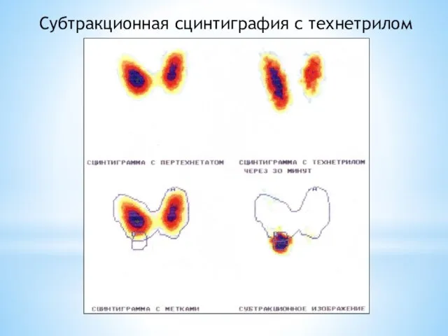 Субтракционная сцинтиграфия с технетрилом