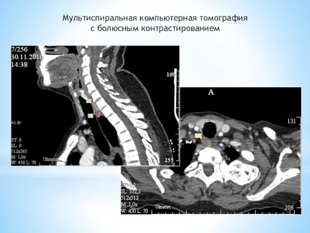 Мультиспиральная компьютерная томография с болюсным контрастированием