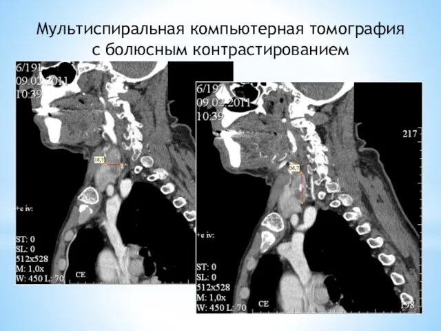 Мультиспиральная компьютерная томография с болюсным контрастированием