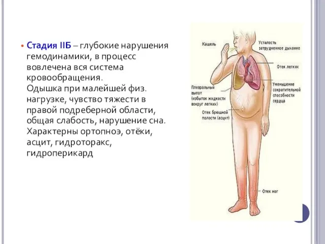 Стадия IIБ – глубокие нарушения гемодинамики, в процесс вовлечена вся система кровообращения.