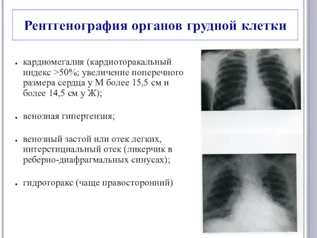 Рентгенография органов грудной клетки кардиомегалия (кардиоторакальный индекс >50%; увеличение поперечного размера сердца