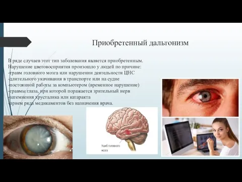 В ряде случаев этот тип заболевания является приобретенным. Нарушение цветовосприятия произошло у