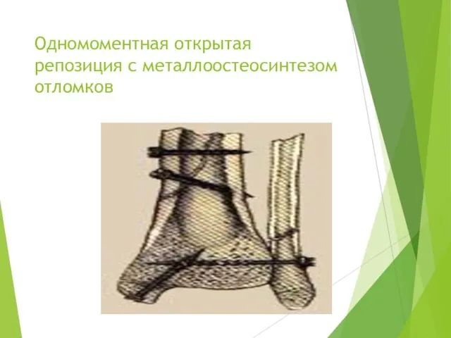 Одномоментная открытая репозиция с металлоостеосинтезом отломков