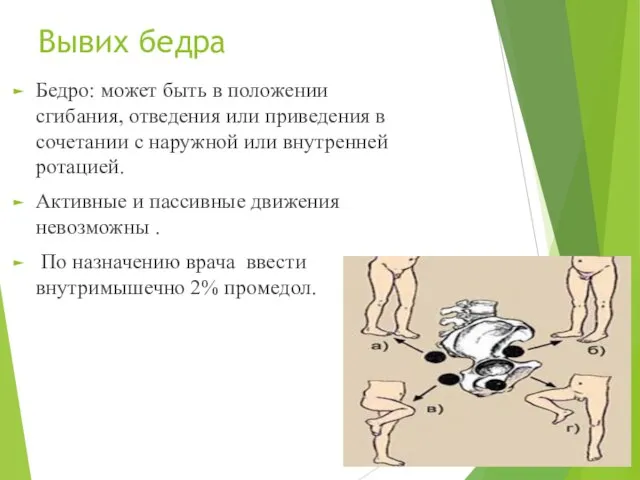 Вывих бедра Бедро: может быть в положении сгибания, отведения или приведения в