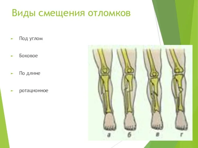 Виды смещения отломков Под углом Боковое По длине ротационное