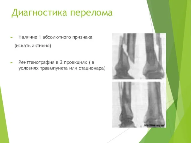 Диагностика перелома Наличие 1 абсолютного признака (искать активно) Рентгенография в 2 проекциях