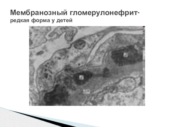 Мембранозный гломерулонефрит- редкая форма у детей