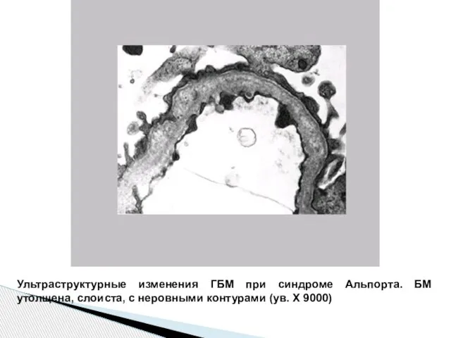 Ультраструктурные изменения ГБМ при синдроме Альпорта. БМ утолщена, слоиста, с неровными контурами (ув. Х 9000)