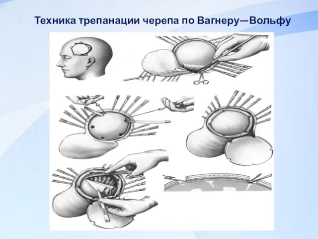 Техника трепанации черепа по Вагнеру—Вольфу