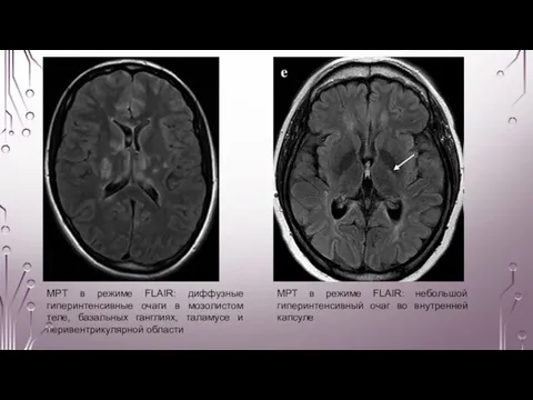 МРТ в режиме FLAIR: диффузные гиперинтенсивные очаги в мозолистом теле, базальных ганглиях,