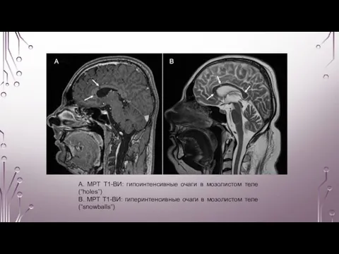 А В А. МРТ Т1-ВИ: гипоинтенсивные очаги в мозолистом теле (“holes”) B.