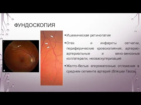 ФУНДОСКОПИЯ Ишемическая ретинопатия Отек и инфаркты сетчатки, периферические кровоизлияния, артерио-артериальные и вено-венозные