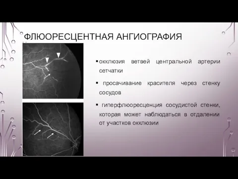 ФЛЮОРЕСЦЕНТНАЯ АНГИОГРАФИЯ окклюзия ветвей центральной артерии сетчатки просачивание красителя через стенку сосудов