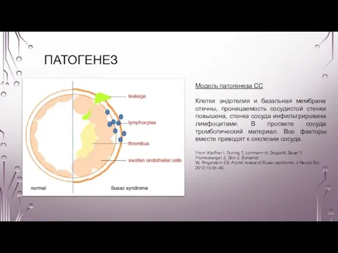 ПАТОГЕНЕЗ Модель патогенеза СС Клетки эндотелия и базальная мембрана отечны, проницаемость сосудистой