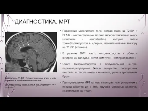 ДИАГНОСТИКА. МРТ Поражение мозолистого тела: острая фаза на Т2-ВИ и FLAIR -
