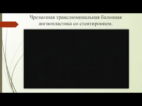 Чрезкозная транслюминальная балонная ангиопластика со стентиронием.