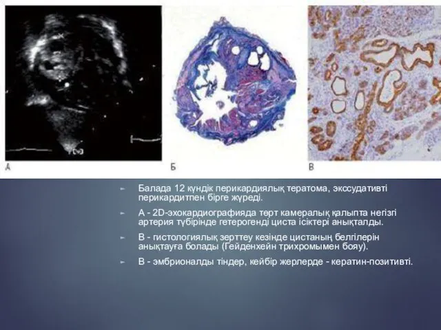 Балада 12 күндік перикардиялық тератома, экссудативті перикардитпен бірге жүреді. A - 2D-эхокардиографияда