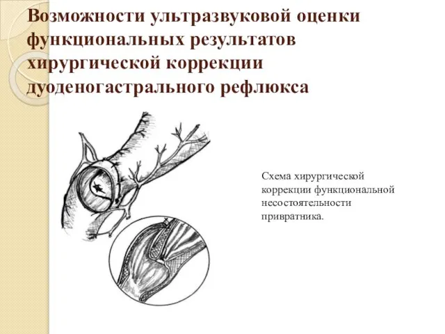 Возможности ультразвуковой оценки функциональных результатов хирургической коррекции дуоденогастрального рефлюкса Схема хирургической коррекции функциональной несостоятельности привратника.