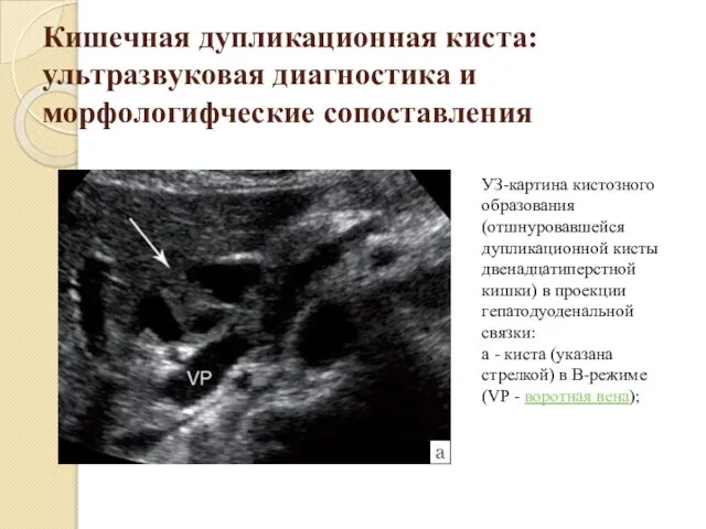 Кишечная дупликационная киста: ультразвуковая диагностика и морфологифческие сопоставления УЗ-картина кистозного образования (отшнуровавшейся