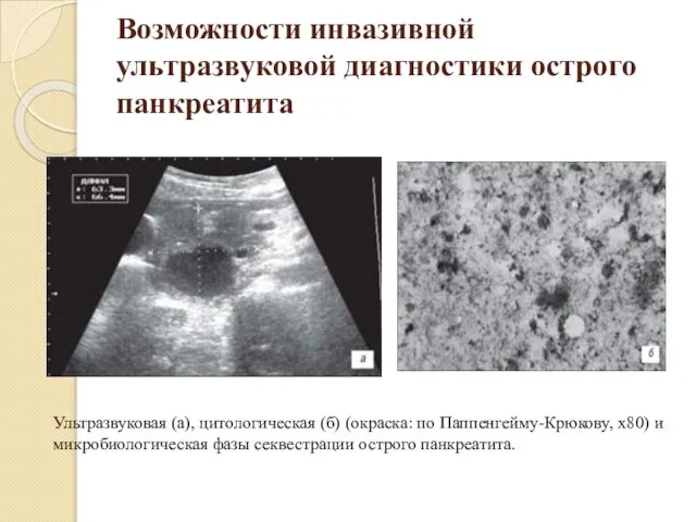 Возможности инвазивной ультразвуковой диагностики острого панкреатита Ультразвуковая (а), цитологическая (б) (окраска: по