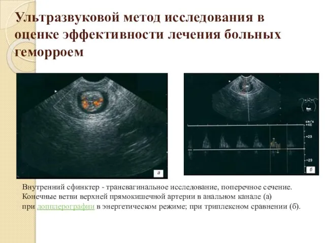 Ультразвуковой метод исследования в оценке эффективности лечения больных геморроем Внутренний сфинктер -