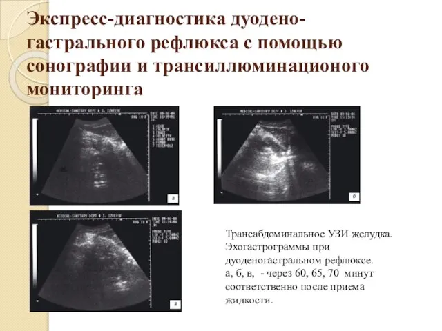 Экспресс-диагностика дуодено-гастрального рефлюкса с помощью сонографии и трансиллюминационого мониторинга Трансабдоминальное УЗИ желудка.