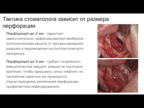 Тактика стоматолога зависит от размера перфорации Перфорация до 2 мм - зарастает