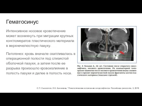 Гематосинус Интенсивное носовое кровотечение может возникнуть при миграции крупных конгломератов пластического материала