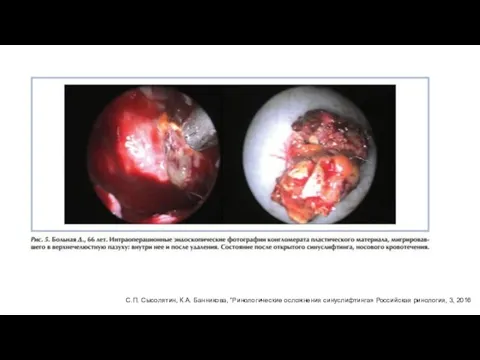 С.П. Сысолятин, К.А. Банникова, “Ринологические осложнения синуслифтинга» Российская ринология, 3, 2016