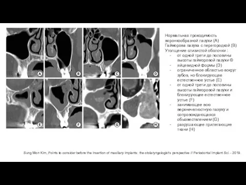 Нормальная проходимость воронкообразной пазухи (A) Гайморова пазуха с перегородкой (В) Утолщение слизистой