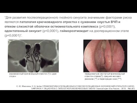 “Для развития послеоперационного гнойного синусита значимыми факторами риска являются патология крючковидного отростка