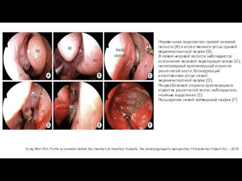 Нормальная эндоскопия правой носовой полости (A) и естественного устья правой верхнечелюстной пазухи