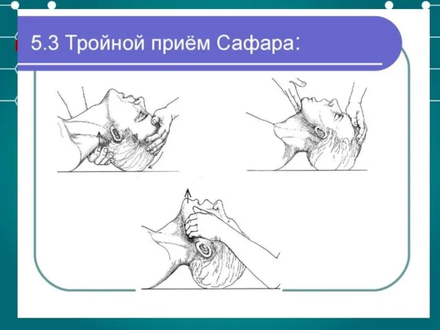 «А» (airway)-обеспечение проходимости верхних дыхательных путей Тройной прием Сафара: запрокидываем голову назад,