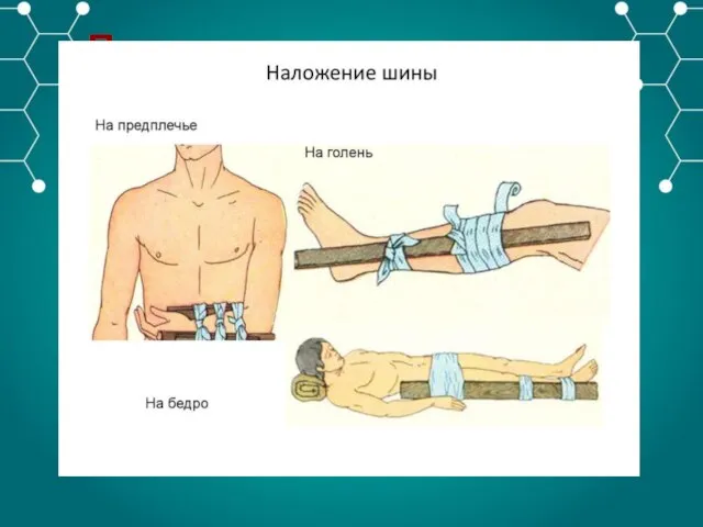 Правила наложения шины: 1)Шина прочная и принимает форму конечности 2)Накладывается на одежду