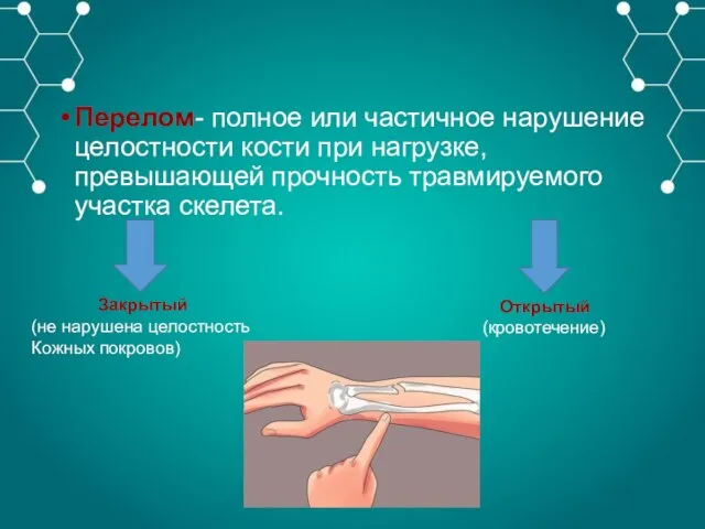 Перелом- полное или частичное нарушение целостности кости при нагрузке, превышающей прочность травмируемого