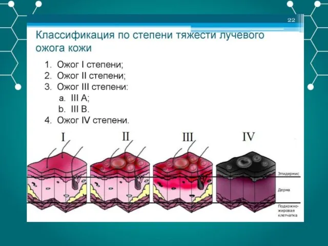 Степени ожогов 1 степень- покраснение, отечность, жжение, резкая боль 2 степень- покраснение,