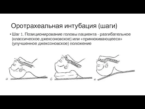 Оротрахеальная интубация (шаги) Шаг 1. Позиционирование головы пациента - разгибательное (классическое джексоновское)