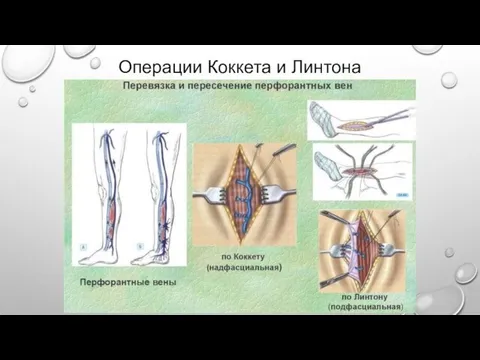 Операции Коккета и Линтона