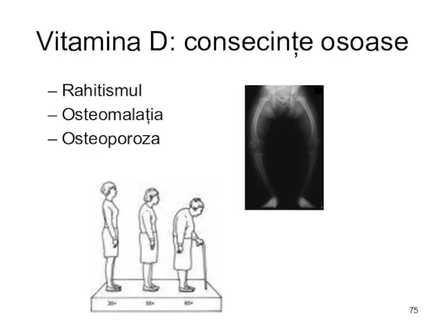 Vitamina D: consecințe osoase Rahitismul Osteomalația Osteoporoza
