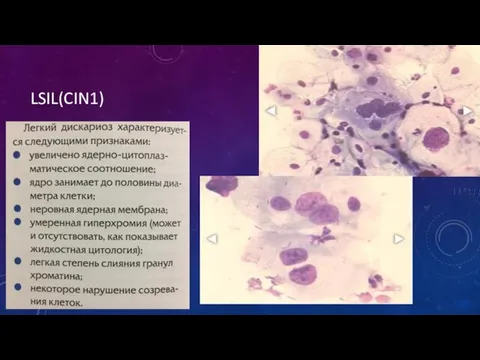 LSIL(CIN1)