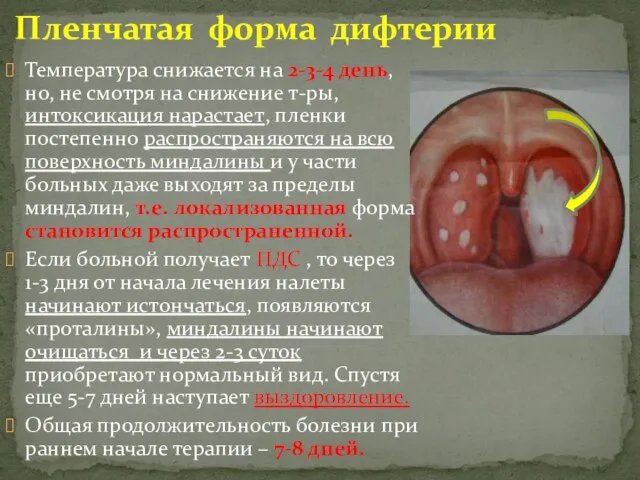 Пленчатая форма дифтерии Температура снижается на 2-3-4 день, но, не смотря на