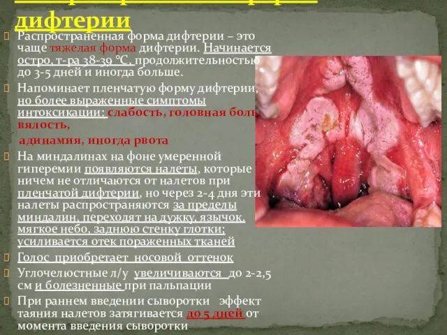 Распространенная форма дифтерии Распространенная форма дифтерии – это чаще тяжелая форма дифтерии.