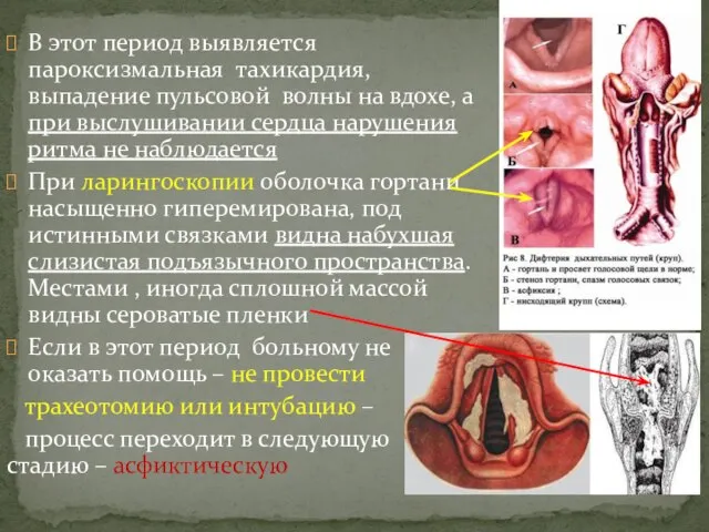 В этот период выявляется пароксизмальная тахикардия, выпадение пульсовой волны на вдохе, а