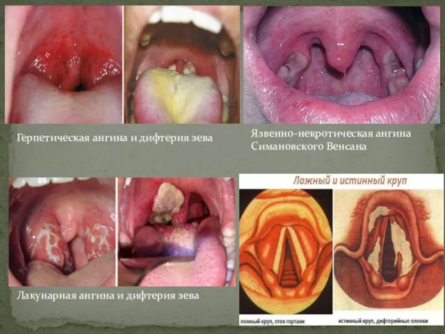Лакунарная ангина и дифтерия зева Герпетическая ангина и дифтерия зева Язвенно-некротическая ангина Симановского Венсана