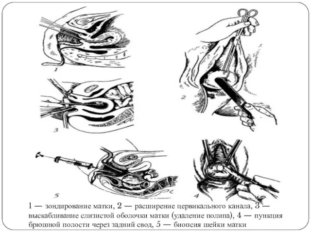 1 — зондирование матки, 2 — расширение цервикального канала, 3 — выскабливание