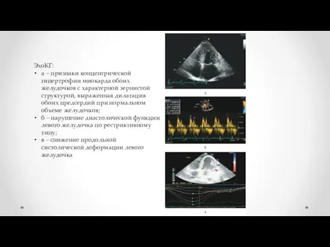 ЭхоКГ: а – признаки концентрической гипертрофии миокарда обоих желудочков с характерной зернистой