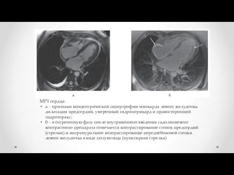МРТ сердца: а – признаки концентрической гипертрофии миокарда левого желудочка, дилатация предсердий,