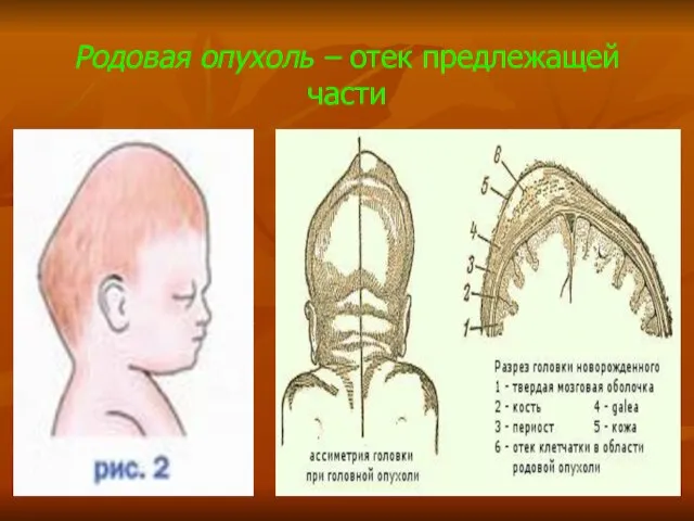 Родовая опухоль – отек предлежащей части