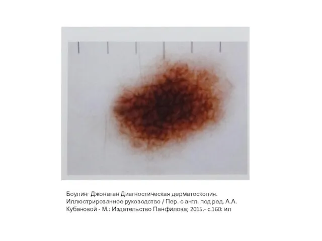 Боулинг Джонатан Диагностическая дерматоскопия. Иллюстрированное руководство / Пер. с англ. под ред.