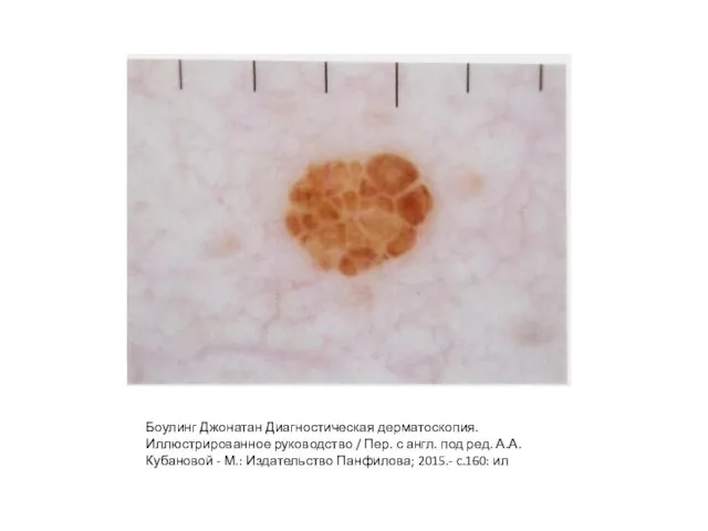 Боулинг Джонатан Диагностическая дерматоскопия. Иллюстрированное руководство / Пер. с англ. под ред.